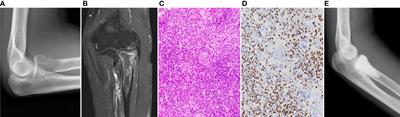 Case Report: Unresectable pulmonary metastases of a giant cell tumor of bone treated with denosumab: a case report and review of literature